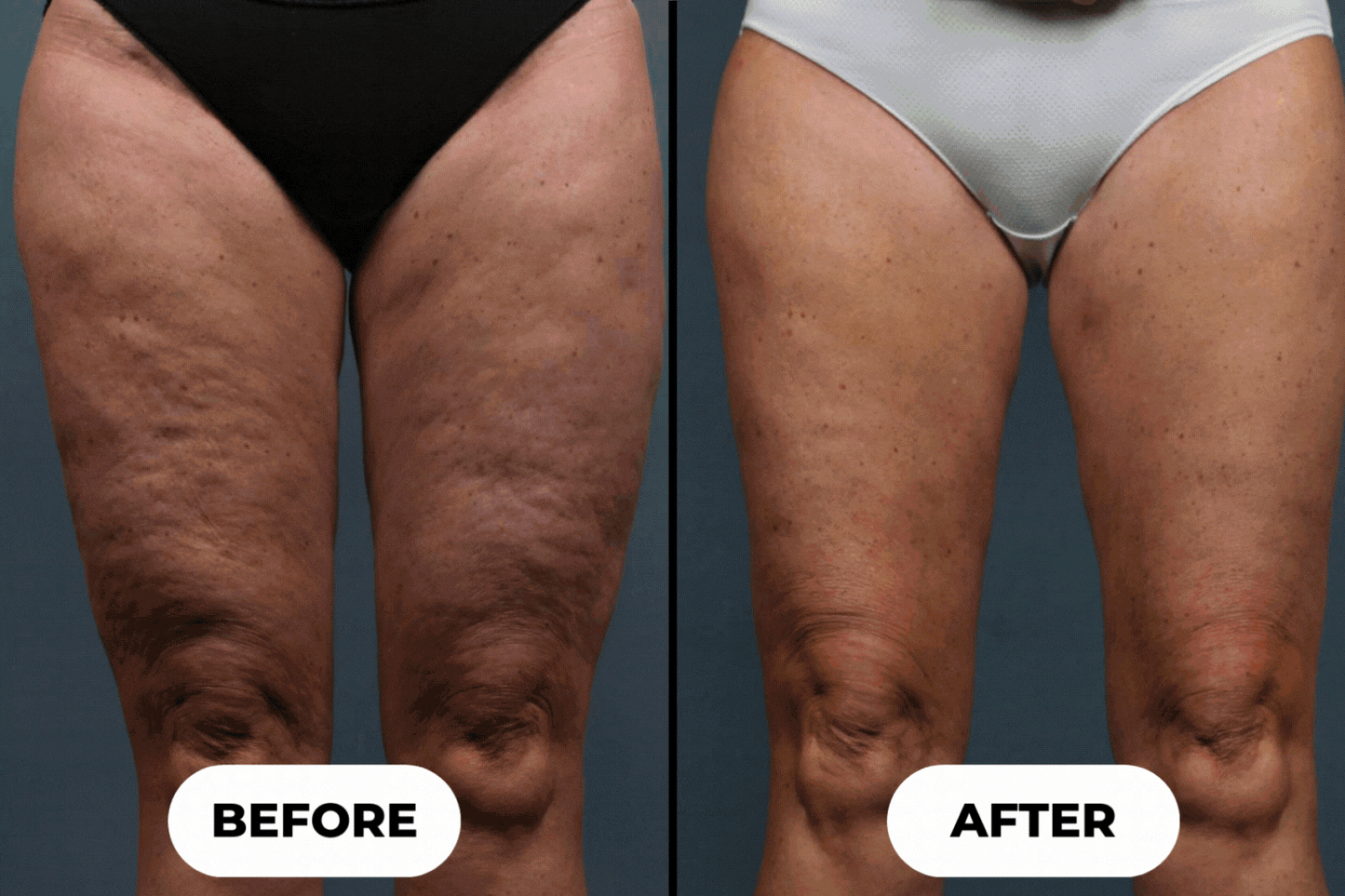 VapoShine LymphaSculpt™: Quad-Action Lymphatic Drainage Massager