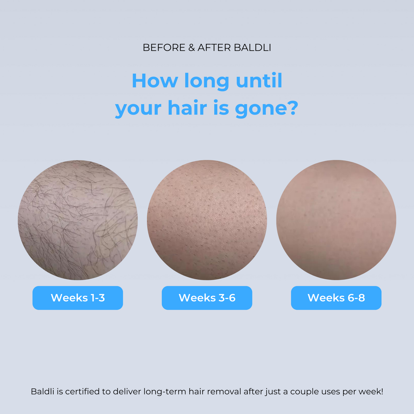 VapoShine Baldli™ Scalp IPL Laser Hair Remover